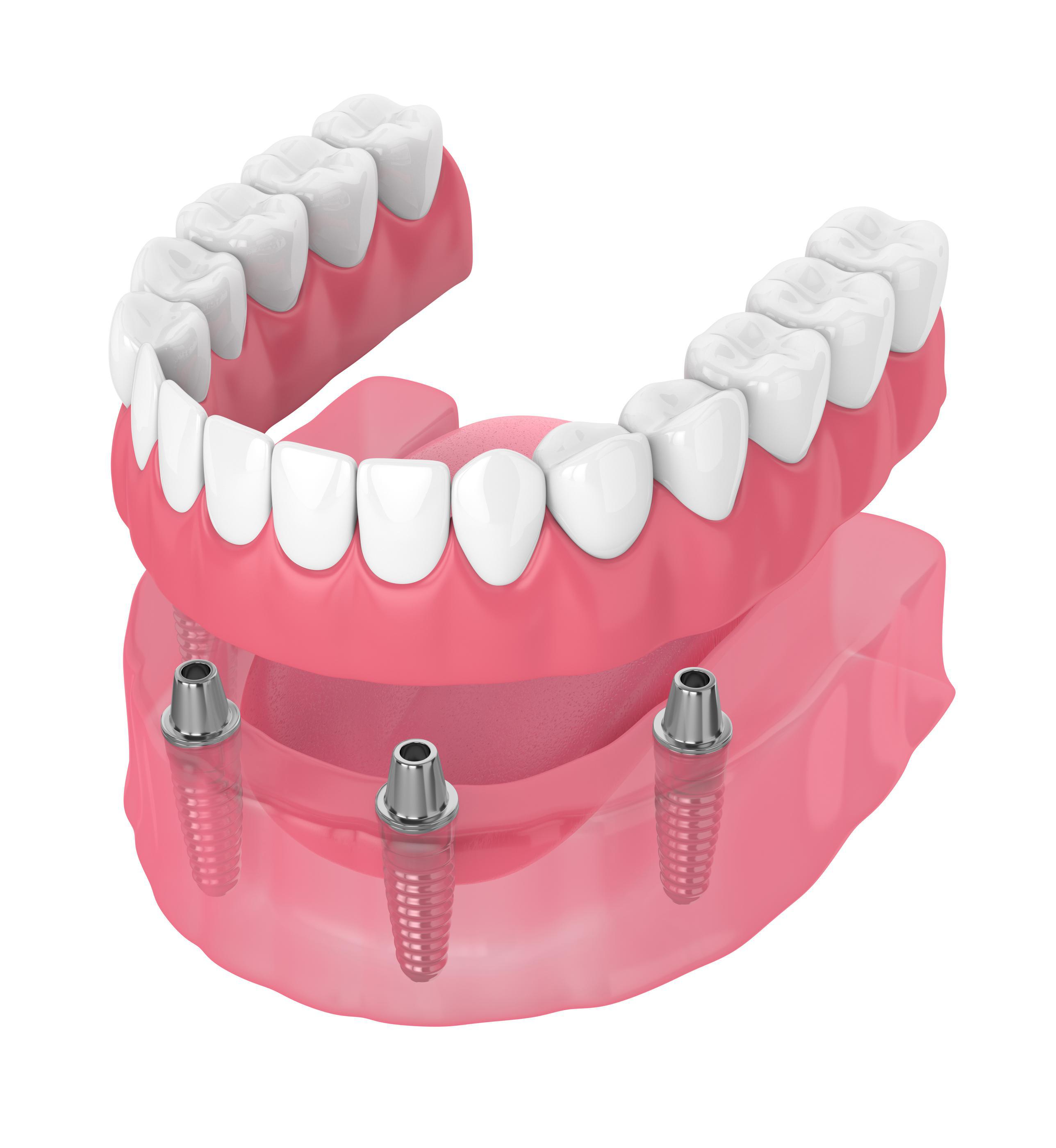 Full Arch Dental Implants in Mankato MN